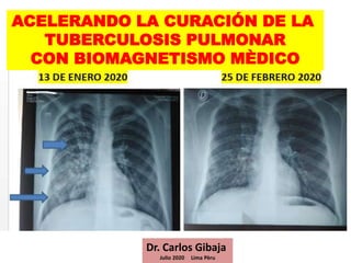ACELERANDO LA CURACIÓN DE LA
TUBERCULOSIS PULMONAR
CON BIOMAGNETISMO MÈDICO
Dr. Carlos Gibaja
Julio 2020 Lima Pèru
 