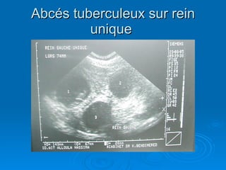 Abcés tuberculeux sur rein unique  