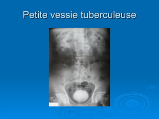 Petite vessie tuberculeuse 