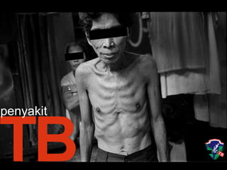 TB
penyakit
 