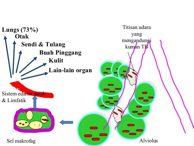 Tuberculosis Talk