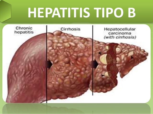 Tbc, Hepatitis B, Neumococo Tbc, Hepatitis B, Neumococo