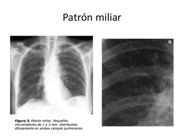 tuberculosis hidatidosis bronquiectasias rx tac dx por imagen 13 638