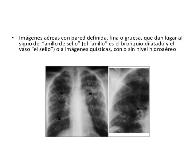 tuberculosis hidatidosis bronquiectasias rx tac dx por imagen 30 638