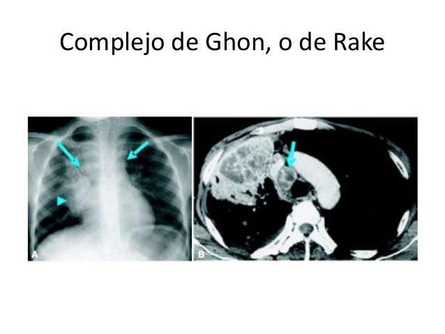 tuberculosis hidatidosis bronquiectasias rx tac dx por imagen 8 638
