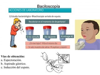 Vias de obtención:
a. Espectoración.
b. Aspirado gástrico.
c. Inducción del esputo.
Baciloscopía
 