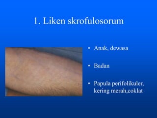 1. Liken skrofulosorum
• Anak, dewasa
• Badan
• Papula perifolikuler,
kering merah,coklat
 
