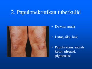 2. Papulonekrotikan tuberkulid
• Dewasa muda
• Lutut, siku, kaki
• Papula keras, merah
kotor, ulserasi,
pigmentasi
 