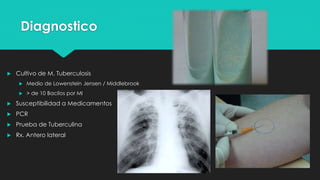 tuberculosis TB | PPTX