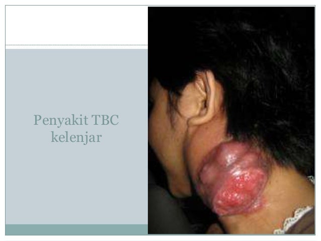 Tbc Ppt