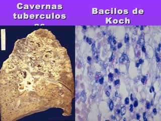 CavernasCavernas
tuberculostuberculos
asas
Bacilos deBacilos de
KochKoch
 