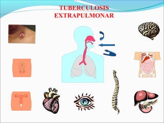 TUBERCULOSIS
EXTRAPULMONAR
 