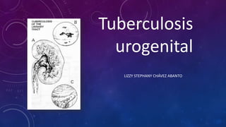 Tuberculosis
urogenital
LIZZY STEPHANY CHÁVEZ ABANTO
 