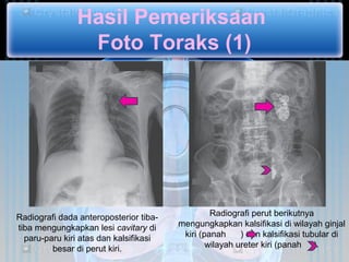 Hasil Pemeriksaan
                Foto Toraks (1)




Radiografi dada anteroposterior tiba-            Radiografi perut berikutnya
tiba mengungkapkan lesi cavitary di     mengungkapkan kalsifikasi di wilayah ginjal
  paru-paru kiri atas dan kalsifikasi    kiri (panah     ) dan kalsifikasi tubular di
         besar di perut kiri.                   wilayah ureter kiri (panah ).
 