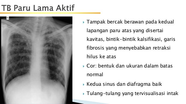 Tb duplex lama aktif