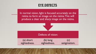 EYE DEFECTS
Defects of vision:
(a) short
sightedness.
(b) long
sightedness.
(c)
astigmatism.
In normal vision, light is focused accurately on the
retina to form an image on the retina.This will
produce a clear and sharp image on the retina.
 