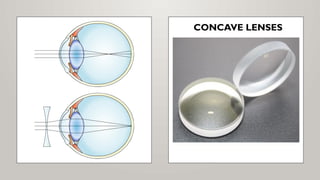 CONCAVE LENSES
 