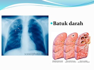 Batuk darah
 