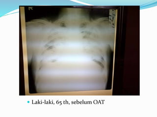  Laki-laki, 65 th, sebelum OAT
 