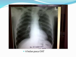  6 bulan pasca OAT
 