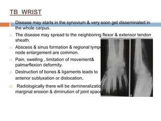 TB WRIST
 Disease may starts in the synovium & very soon get disseminated in
the whole carpus.
 The disease may spread to the neighboring flexor & extensor tendon
sheath.
 Abscess & sinus formation & regional lympoh
node enlargement are common.
 Pain, swelling , limitation of movement&
palmarflexion deformity.
 Destruction of bones & ligaments leads to
anterior subluxation or dislocation.
 Radiologically there will be demineralization,
marginal erosion & diminution of joint spaces
 