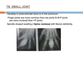 TB SMALL JOINT
Develop in juxta-articular bone or in the synovium.
Finger joints are more common than toe joints & M-P joints
are more involved than I-P joints.
Spindle shaped swelling ( Spina ventosa) with flexion defotmity.
 