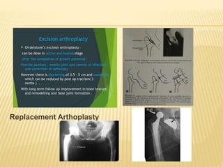Replacement Arthoplasty
 