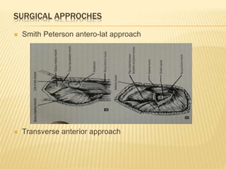 SURGICAL APPROCHES
 Smith Peterson antero-lat approach
 Transverse anterior approach
 