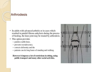 Arthrodesis
 