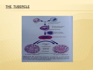 THE TUBERCLE
 
