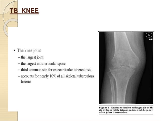 Knee Tuberculosis Of The Bone Cloudshareinfo