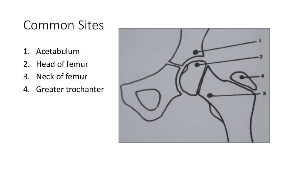 TUBERCULOSIS OF HIP JOINT