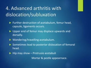 4. Advanced arthritis with
dislocation/subluxation
 Further destruction of acetabulum, femur head,
capsule, ligaments occurs.
 Upper end of femur may displace upwards and
dorsally.
 Wandering/travelling acetabulum.
 Sometimes lead to posterior dislocation of femoral
head.
 Hip may show – Protrusio acetabuli
Mortar & pestle appearnace.
 