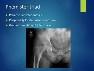 Phemister triad
 Periarticular osteoporosis
 Peripherally located osseous erosion
 Gradual diminition of joint space.
 