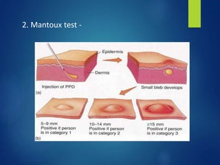 2. Mantoux test -
 