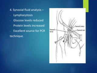 4. Synovial fluid analysis –
- Lymphocytosis
- Glucose levels reduced
- Protein levels increased
- Excellent source for PCR
technique.
 