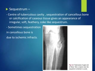  Sequestrum –
- Centre of tuberculous cavity , sequestration of cancellous bone
or calcification of caseous tissue gives an appearance of
irregular, soft, feathery, coke like sequestrum.
- Sometimes sequestration
in cancellous bone is
due to ischemic infracts.
 