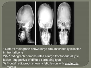 Tb hip knee shoulder dactylitis | PPTX