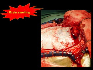 Brain swelling 