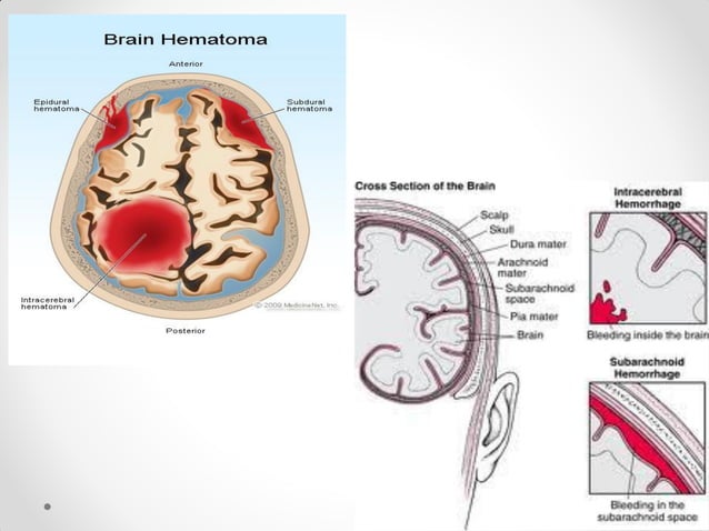 Traumatic brain injury | PPT