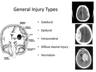 General Injury Types
• Subdural
• Epidural
• Intracerebral
• Diffuse Axonal Injury
• Herniation
 