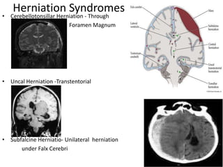 Herniation Syndromes
• Cerebellotonsillar Herniation - Through
Foramen Magnum
• Uncal Herniation -Transtentorial
• Subfalcine Herniatio- Unilateral herniation
under Falx Cerebri
 