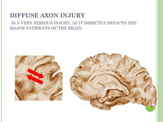 DIFFUSE AXON INJURY
IS A VERY SERIOUS INJURY, AS IT DIRECTLY IMPACTS THE
MAJOR PATHWAYS OF THE BRAIN.
 