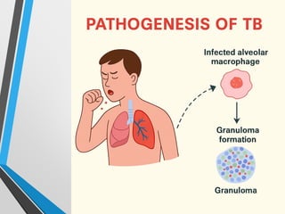 Pediatric Tuberculosis- Tuberculosis in Children | PPTX
