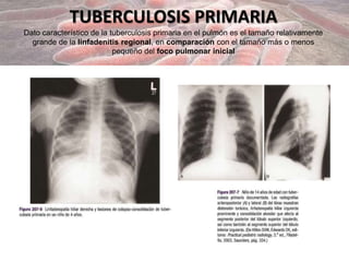 TUBERCULOSIS PRIMARIA
Dato característico de la tuberculosis primaria en el pulmón es el tamaño relativamente
grande de la linfadenitis regional, en comparación con el tamaño más o menos
pequeño del foco pulmonar inicial
 