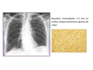 Pequeños micronodulos 1-3 mm en
ambos campos pulmonares (granos de
mijo)
 