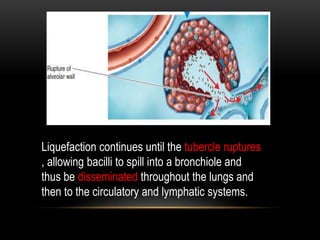 Liquefaction continues until the tubercle ruptures
, allowing bacilli to spill into a bronchiole and
thus be disseminated throughout the lungs and
then to the circulatory and lymphatic systems.
 