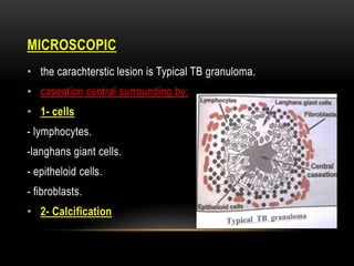MICROSCOPIC
• the carachterstic lesion is Typical TB granuloma.
• caseation central surrounding by:
• 1- cells
- lymphocytes.
-langhans giant cells.
- epitheloid cells.
- fibroblasts.
• 2- Calcification
 