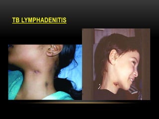 TB LYMPHADENITIS
 