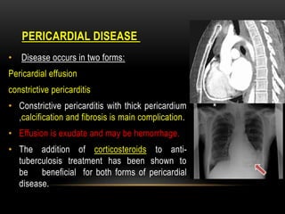 PERICARDIAL DISEASE
• Disease occurs in two forms:
Pericardial effusion
constrictive pericarditis
• Constrictive pericarditis with thick pericardium
,calcification and fibrosis is main complication.
• Effusion is exudate and may be hemorrhage.
• The addition of corticosteroids to anti-
tuberculosis treatment has been shown to
be beneficial for both forms of pericardial
disease.
 
